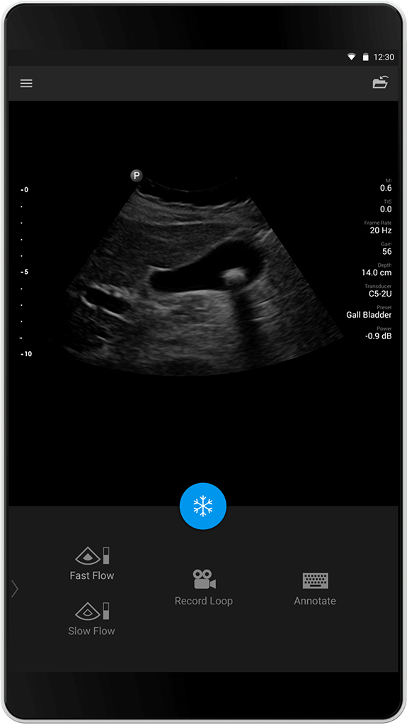 Gallbladder (Gallebl&aelig;re), C5-2